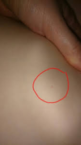 Avoid trauma such as bumping or pulling on skin areas. Red Spots Petechiae Should I Be Worried Mumsnet