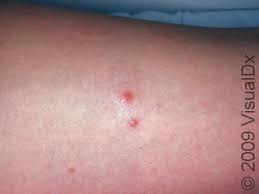 Image result for bedbugs bites