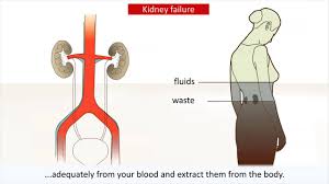 Kidney Disease Causes And Treatment Of Kidney Failure Youtube Alibaba.com offers 826 kidney cartoon products. kidney disease causes and treatment of kidney failure