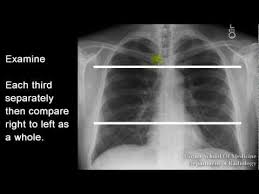Chest Xray Respiratory Care Emergency Nursing Respiratory Therapy