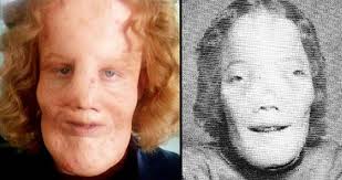 Rocky Dennis: The True Story Of The Boy Who Inspired 'Mask'