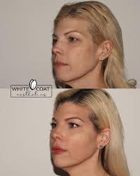 Look at these gorgeous full facial balancing results!😍 I treated my  beautiful client with filler in the cheeks, lips, and chin to create  symmetry and a rejuvenated look. She asked for height