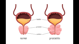 Image result for Chronic Bacterial Prostatitis