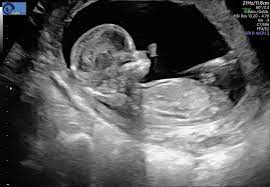 In welchen monat wächst er am schnellsten? Sieht Man Welches Geschlecht Babyforum At