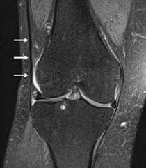 The normal anatomy of the knee as seen on magnetic resonance. Normal Magnetic Resonance Imaging Anatomy Of The Capsular Ligamentous Supporting Structures Of The Knee Sciencedirect