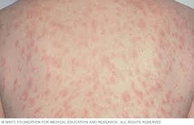 النخالية الوردية الأعراض والأسباب Mayo Clinic مايو كلينك