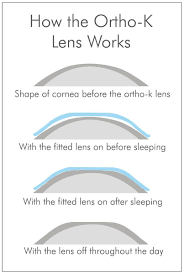 Orthokeratology Contact Lenses The Eye Practice Eye Facts Optometry Eye Health