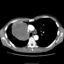 Ct scan of the cervical spine. Superior Vena Cava Obstruction From Lung Cancer Radiology Case Radiopaedia Org