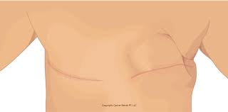 Image result for Mastectomy