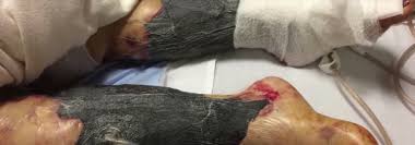 Både folk og bakterier stortrives i det varme badevannet i oslofjorden. Bakterier Spiste Henne Opp Innenfra Da Hun Spiste Favorittretten Na Advarer Familien Smud No