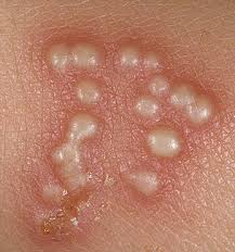 Resultado de imagen de herpes en la piel