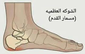 محبى مريم نور علاج مسمارالقدم الشوكه العظميه الحجامة Facebook