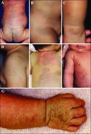 Image result for Diffuse Hyperpigmentation