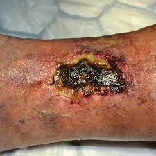 As this happens, muscles and bones are affected together with the neighboring structures. Triad Wound Dressing Wound Care Wounds Coloplast Coloplast Us