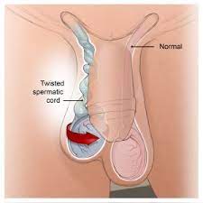 How can i tell if i have testicular torsion? Treating Testicular Torsion Surgical Specialists Chesapeake Urology
