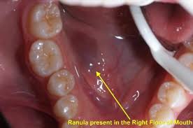 Ranulas Ranulae And Their Treatment Salivary Gland Infection Salivary Gland Oral Anatomy