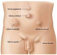Hernias Flashcards Quizlet
