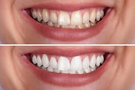 We did not find results for: Teeth Whitening Teeth Whitening Mistakes Dr D Michael Miller