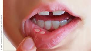 Canker Sores A Pain In The Mouth Old Farmer S Almanac