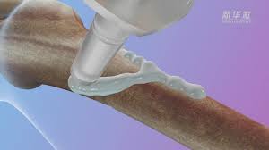 Chinese researchers on Tuesday unveiled their self-developed world's first “bone  glue” material capable of securely bonding fractured bone fragments within  2-3 minutes in a blood-rich environment. Inspired by oysters, this new  biomaterial,