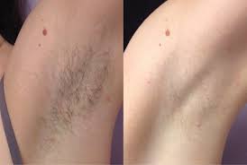 Laser hair removal makes the skin more sensitive and susceptible to sun damage. Laser Hair Removal Skinologie Beaumont