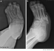 Correct diagnosis and treatment of acute charcot are imperative to decrease permanent foot deformity and allow for a stable and plantigrade foot that is . Role Of The General Surgeon In The Early Diagnosis And Treatment Of Charcot Foot Cirugia Espanola English Edition