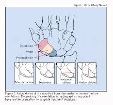 Image result for Scaphoid Fracture Signs