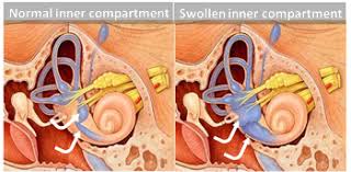 Image result for Inner Ear Decompression Sickness