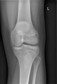 Jumper's knee, osteochondral injury, and excessive lateral pressure  syndrome,