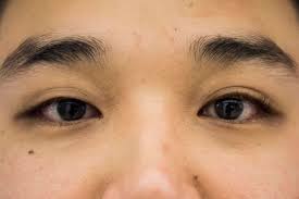 Ptpn11, kras, sos1 rit1 and raf1.ptpn11 mutations have been found in approximately 50% of affected individuals; 13 Asians On Identity And The Struggle Of Loving Their Eyes Huffpost