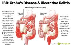 Pin On Inflammatory Bowel Disease Ibd