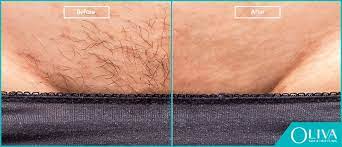 Laser hair removal cost is a fee schedule that the hair removal specialist has set up. Laser Bikini Brazilian Hair Removal Procedure Cost Results