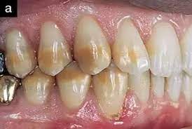Use a remineralizing fluoride and nanohydroxyapatite toothpaste to help do so. How To Remove Stains From Braces On Your Teeth Quora