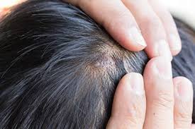This makes it more shocking when you consider how many people have to deal with it. 10 Body Parts Affected By Psoriasis