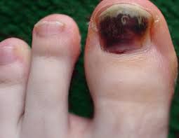 If your black spots under toenail did not come from a direct injury or obvious nail fungus, you will need to see your doctor to ensure a toenail fungus, also known as onychomycosis, is a common nail affliction that can usually be safely removed with prescription therapy over a long period of time. Black Toenail Cancer In North Texas Graff Foot Ankle And Wound Care