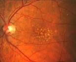 Everything you need to know about age-related macular degeneration ...