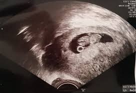 Entwicklung des ganzen körpers und einzelner organe des kleinen. Ultraschallbilder Mehr Als 50 Bilder Aus Der Schwangerschaft Faminino