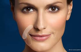 Restylane is fda cleared to last up to about 12 months however the placement (amount, location, technique) of filler can significantly impact longevity. Plastic Surgery Of Texas Dr Tittle