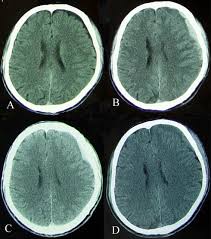 Image result for Hydrothauma