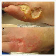 Image result for Hyperviscosity Syndrome