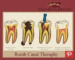 Frandsen Dental Root Canal Therapy Root Canal Treatment Root Canal Gum Disease Remedies