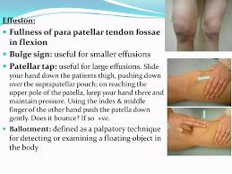 Image result for Knee Bulge Sign