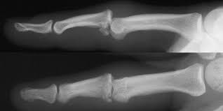 Image result for Interphalangeal Dislocation