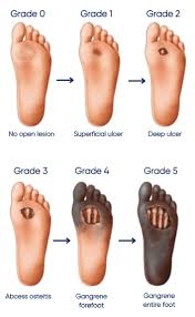 Image result for diabetic toes