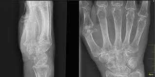 Zoledronic Acid May Increase Bone Density In Frail Elderly Women 2 Minute Medicine
