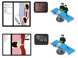 Image result for Intrapleural Anesthesia