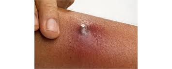 How To Care For Your Child With An Abscess | Sidra Medicine