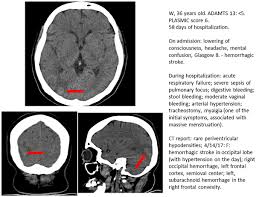 Image result for Plasmic Score