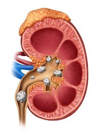 Image result for Nephrolithiasis