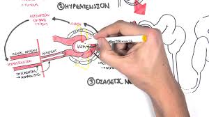Chronic Kidney Disease Ckd Pathophysiology Youtube Polycystic Kidney Disease Chronic Kidney Disease Kidney Symptoms
